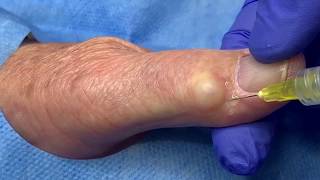 Ganglion Cyst Jelly Doughnut Hole Extraction [upl. by Nurse99]