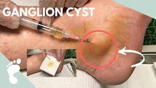 Draining a Ganglion Cyst Using a Syringe [upl. by Sorce]