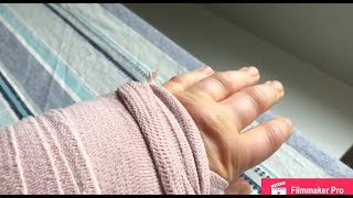 Ganglion Cyst Removal Surgery Review [upl. by Borchers]